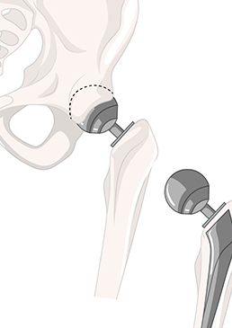 hip replacement