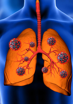 pulmonary fibrosis