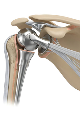shoulder replacement